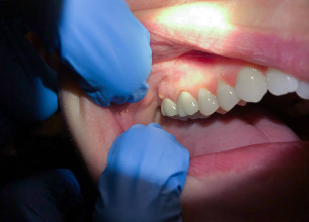 Best Emergency Root Canal Treatment in Long Hill, CT