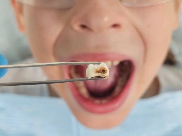 Best Emergency Dentist for Lost Fillings or Crowns in Long Hill, CT
